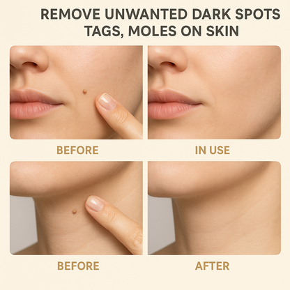 Lanbena™️Organic Skin Tag Remover Serum | All Natural For Warts