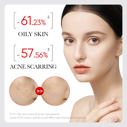 👏🌟LUVENZA® Acid Acne Treatment Essence: Skin-nourishing, moisturizing, and fades acne scars and pimples