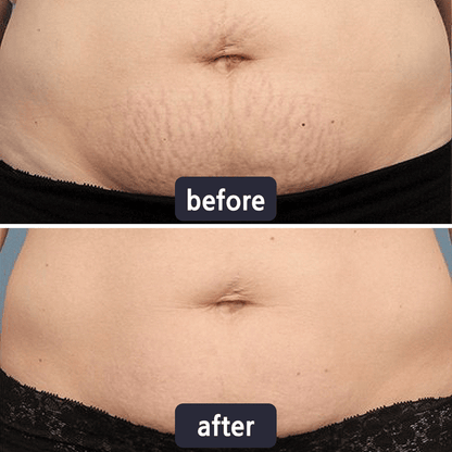 Miasaki Scar Removal Cream