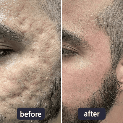 Miasaki Scar Removal Cream